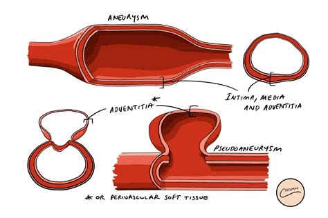 false aneurysm vs pseudoaneurysm.